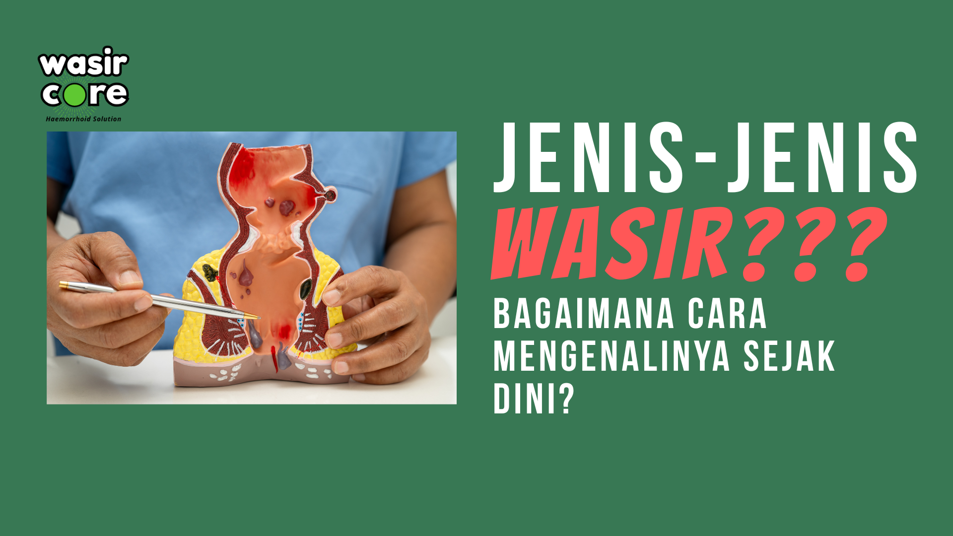 Jenis-Jenis Wasir dan Cara Mengenalinya Sejak Dini